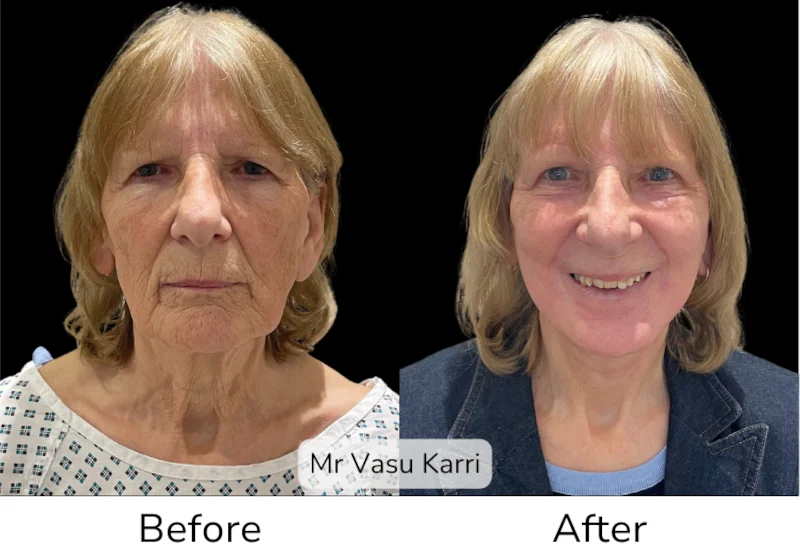 Facelift Patient 9 View 1